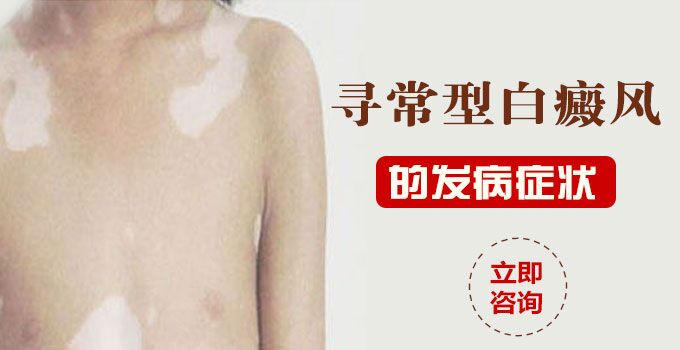 寻常型白癜风的发病症状？(图1)