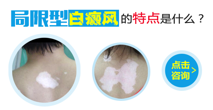 局限型白癜风的特点是什么?(图1)